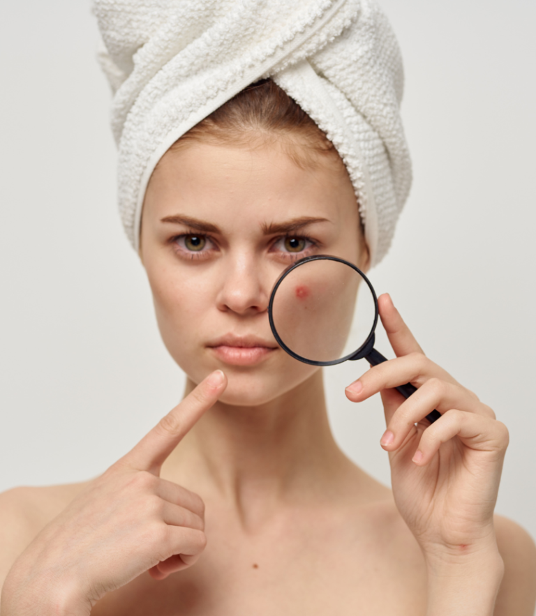 Cara Mengatasi Jerawat Secara Alami Dan Skincare Yang Tepat Untuk Kulit Berjerawat